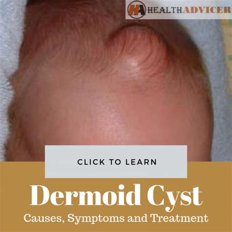 can a cyst be hard.